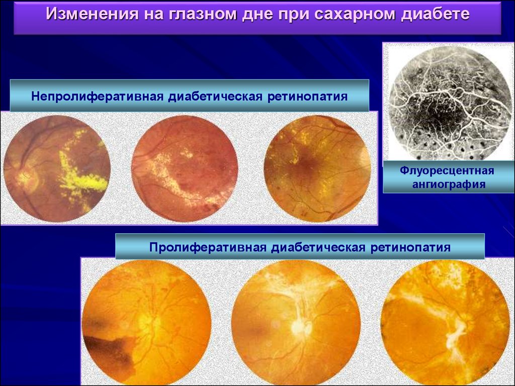 Диабетическая ретинопатия презентация офтальмология - 83 фото