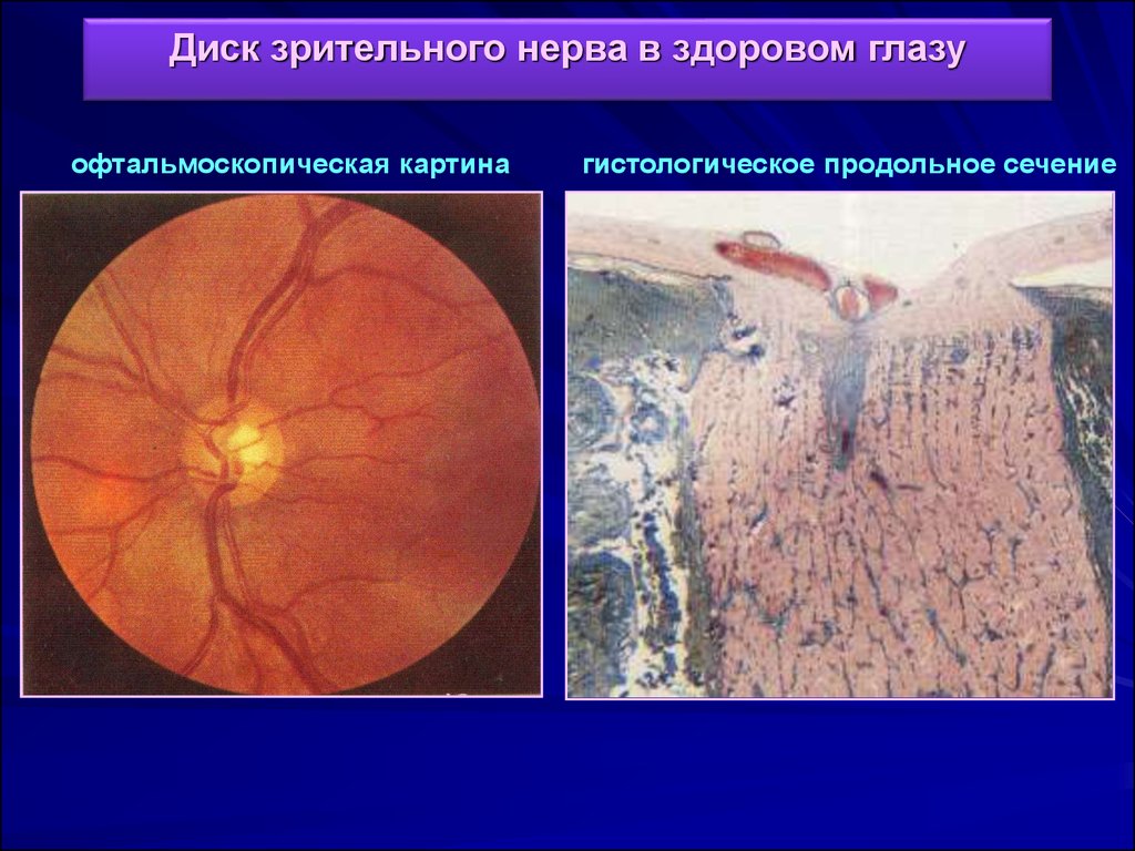 Диск зрительного нерва. Псевдозастойный диск зрительного нерва. Диск зрительного нерва гистология. Описание диска зрительного нерва. Из чего состоит диск зрительного нерва.