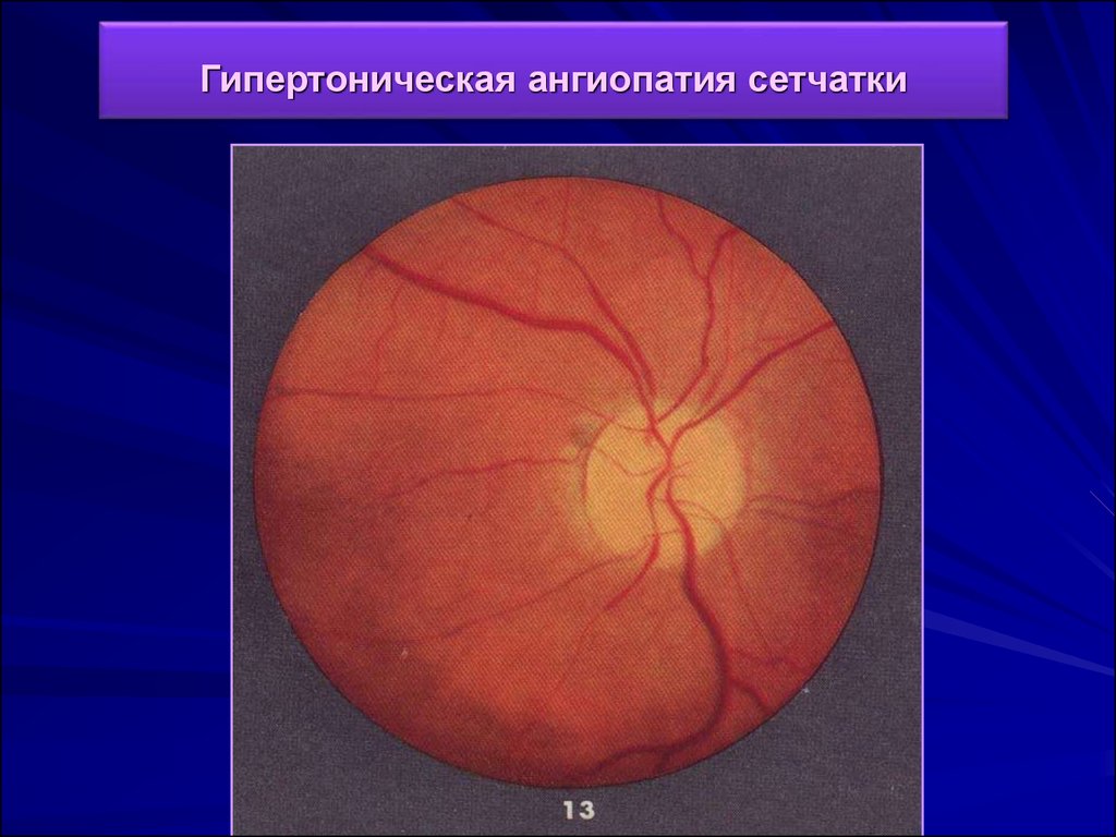 Ангиопатия сетчатки мкб 10. Гипертоническая ангиопатия сетчатки. Гипертензионная ангиопатия сетчатки что это. Гипертоническая ангиопатия и ретинопатия. Ангиопатия сосудов сетчатки мкб.