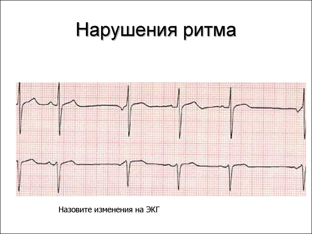 Патологическая экг