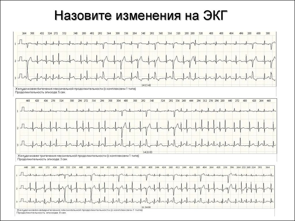 Можно ли экг при беременности. ЭКГ при беременности. Изменения ЭКГ при беременности. ЭКГ плода при беременности. ЭКГ при беременности на ранних сроках.