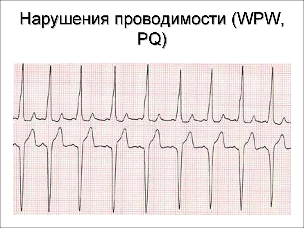 Что значит нарушение проводимости. Нарушение сердечной проводимости. Нарушение функции проводимости сердца. Нарушение проводимости сердца на ЭКГ. Нарушение проходимости сердце.