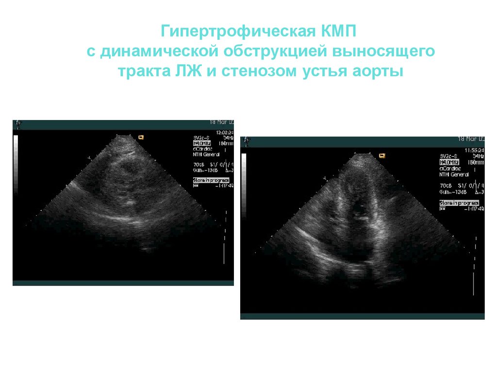 Обструкция выходного тракта левого желудочка. Обструкция выносящего тракта левого желудочка ЭХОКГ. Обструкция ВТЛЖ ЭХОКГ. Обструкция выносящего тракта лж. Гипертрофическая кардиомиопатия с обструкцией выносящего тракта.