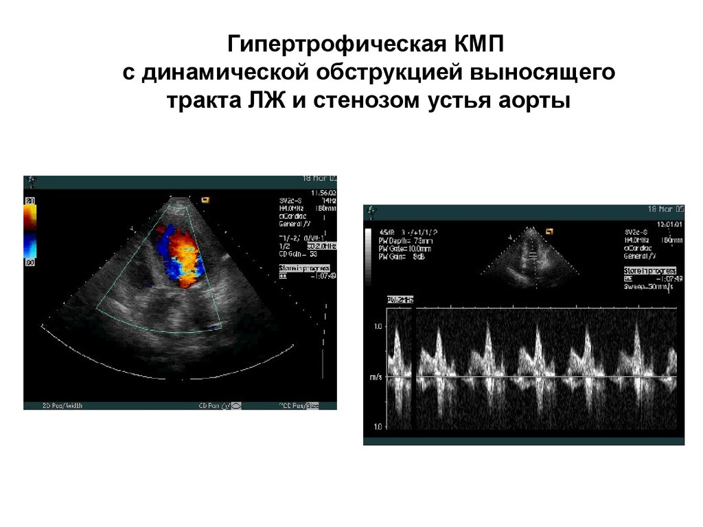 Обструкция выходного тракта левого желудочка