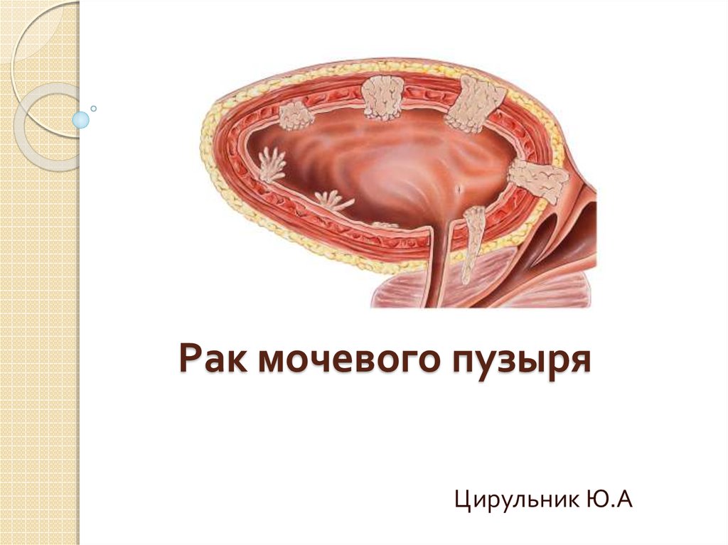 Рецидив рак мочевого. Уротелиальная карцинома мочевого пузыря. Опухоль карцинома мочевого пузыря. Стадии опухоли мочевого пузыря. Неинвазивная папиллярная уротелиальная карцинома мочевого пузыря.