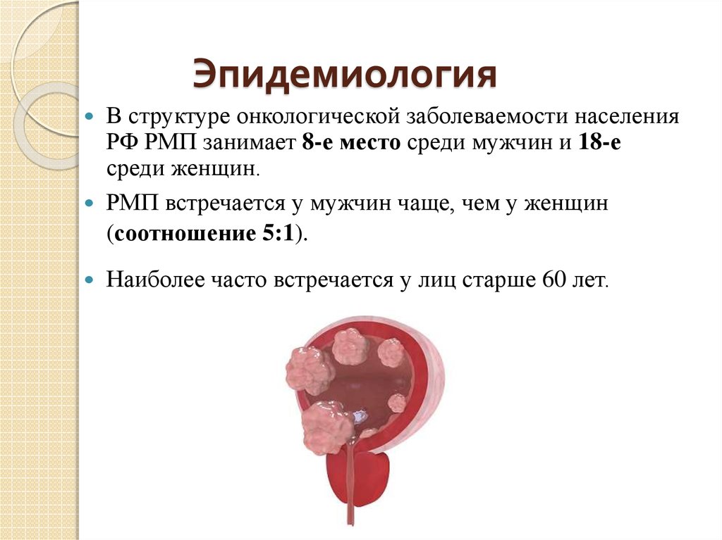 Рецидив рак мочевого. Рецидивные опухоли мочевого пузыря. Структура эпидемиологии. Опухоли мочевого пузыря презентация.