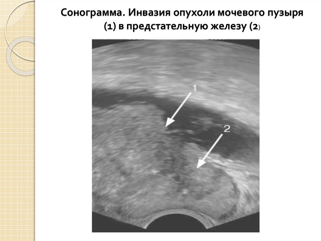 Удаление мочевого пузыря при раке. Фиброма мочевого пузыря УЗИ. Карцинома мочевого пузыря т1. Сонограмма предстательной железы.