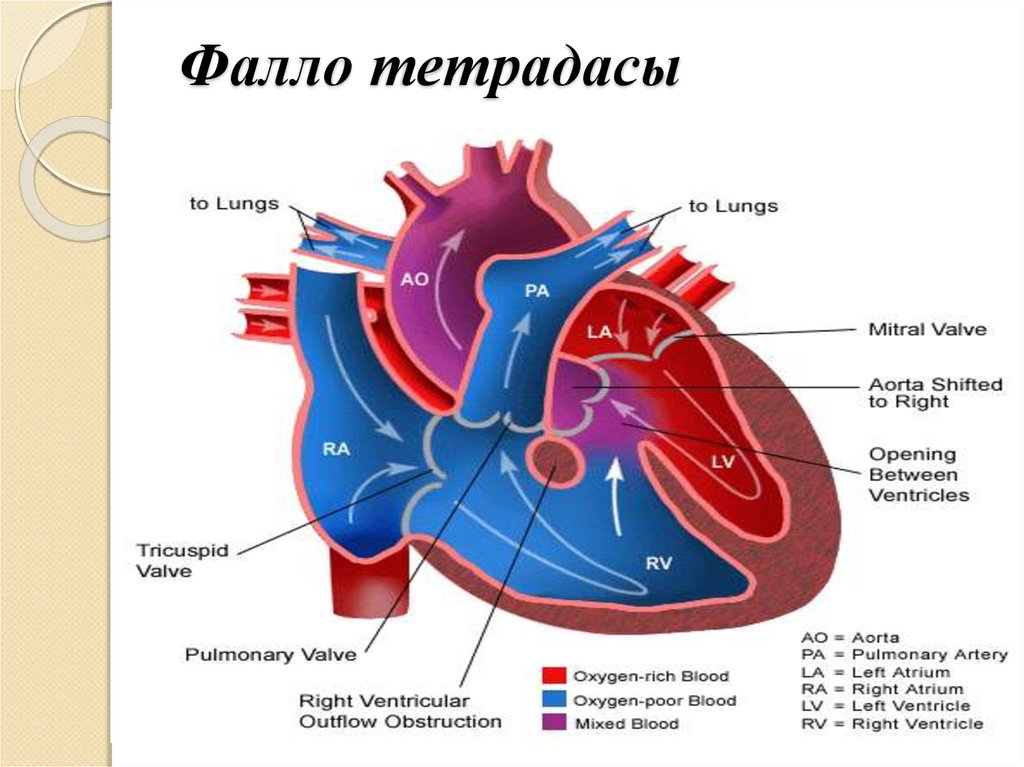 Триада фалло презентация