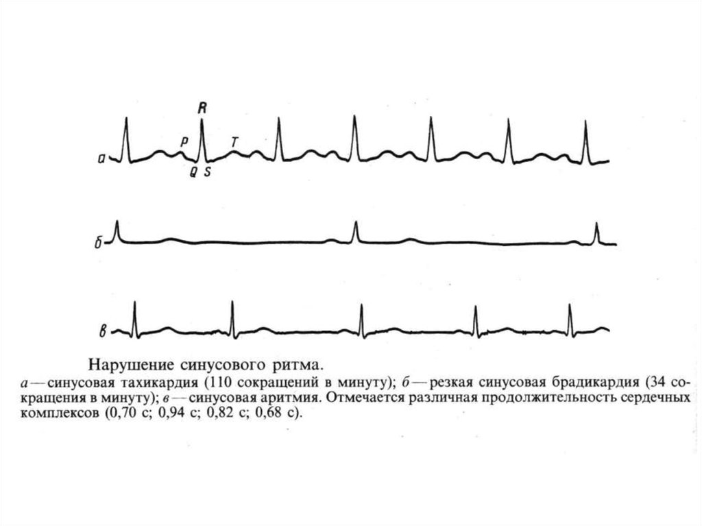Тахикардия и брадикардия. Норма ЭКГ синусный ритм. Синусовые нарушения ритма ЭКГ. Синусовая аритмия на ЭКГ. Критерии синусового ритма на ЭКГ.
