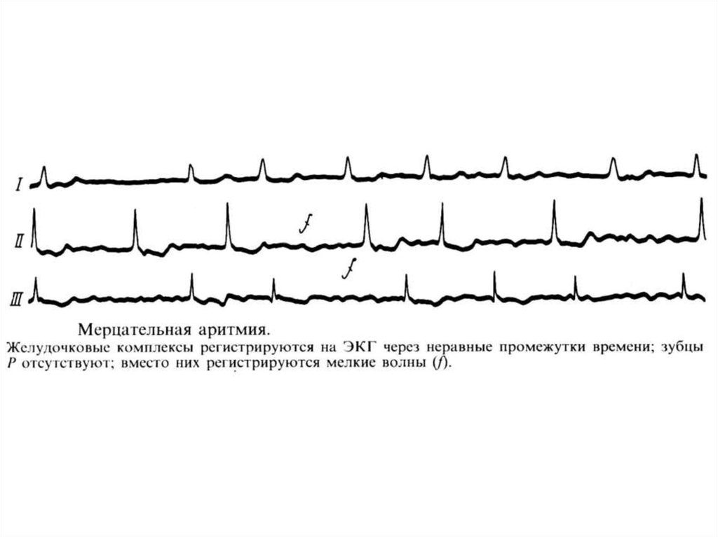 Желудочковое нарушение. Постоянная форма мерцательной аритмии ЭКГ. Мерцательная аритмия схема ЭКГ. Синусовая Мерцательная аритмия ЭКГ. ЭКГ пленка Мерцательная аритмия.