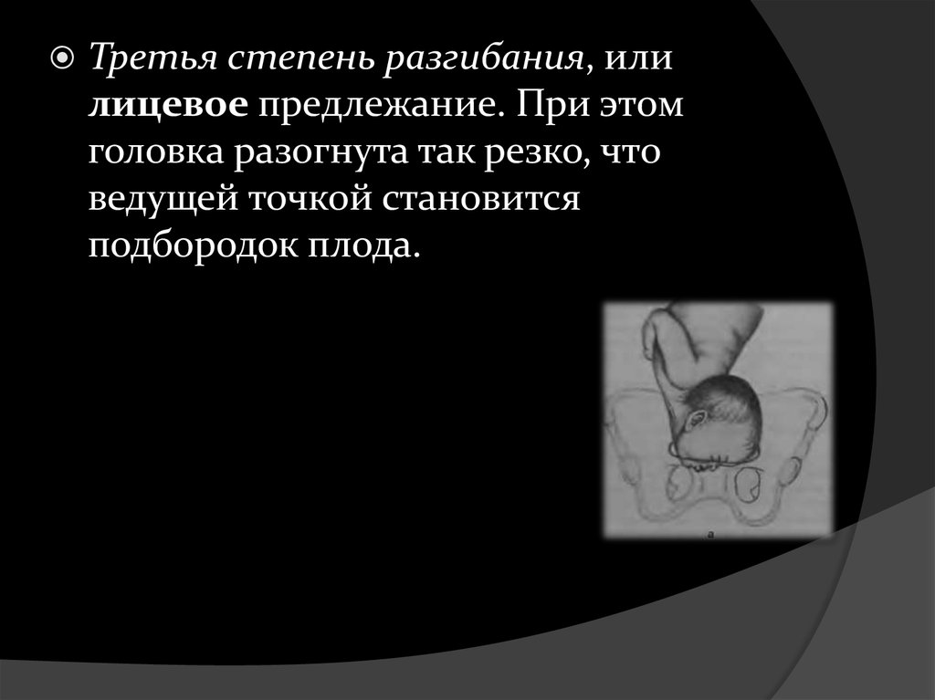 Причины тазового предлежания. Роды при лицевом предлежании. Лицевое предлежание плода. Точки фиксации при лицевом предлежании. Проводная точка при лицевом предлежании.