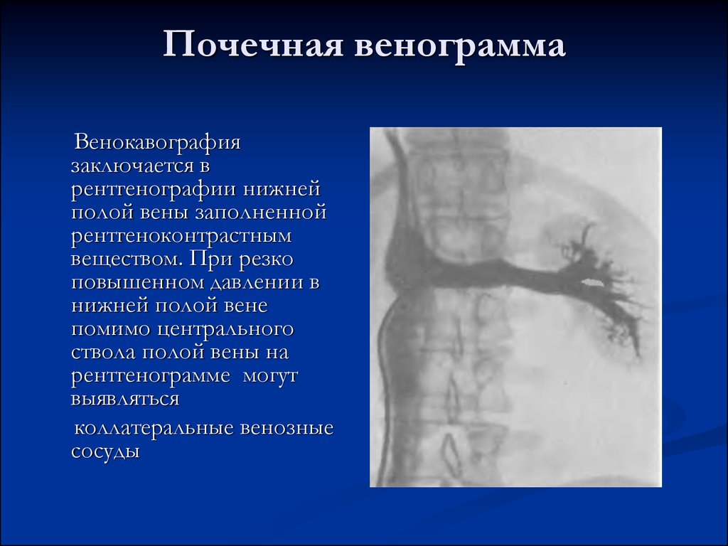 Увеличение полой. Нижняя полая Вена на рентгенограмме. Рентгенограмма вен почки.