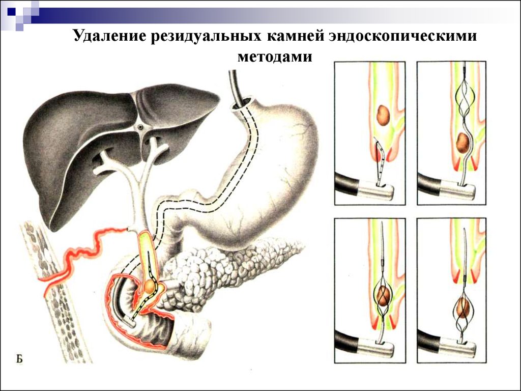 Операция желчнокаменной болезни