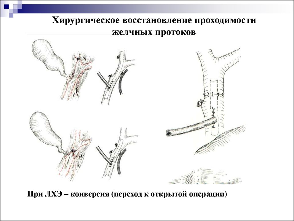 Перенесенная холецистэктомия. Культя пузырного протока. Нарушение проходимости желчных протоков. Постхолецистэктомический синдром. Синдром длинной культи пузырного протока.