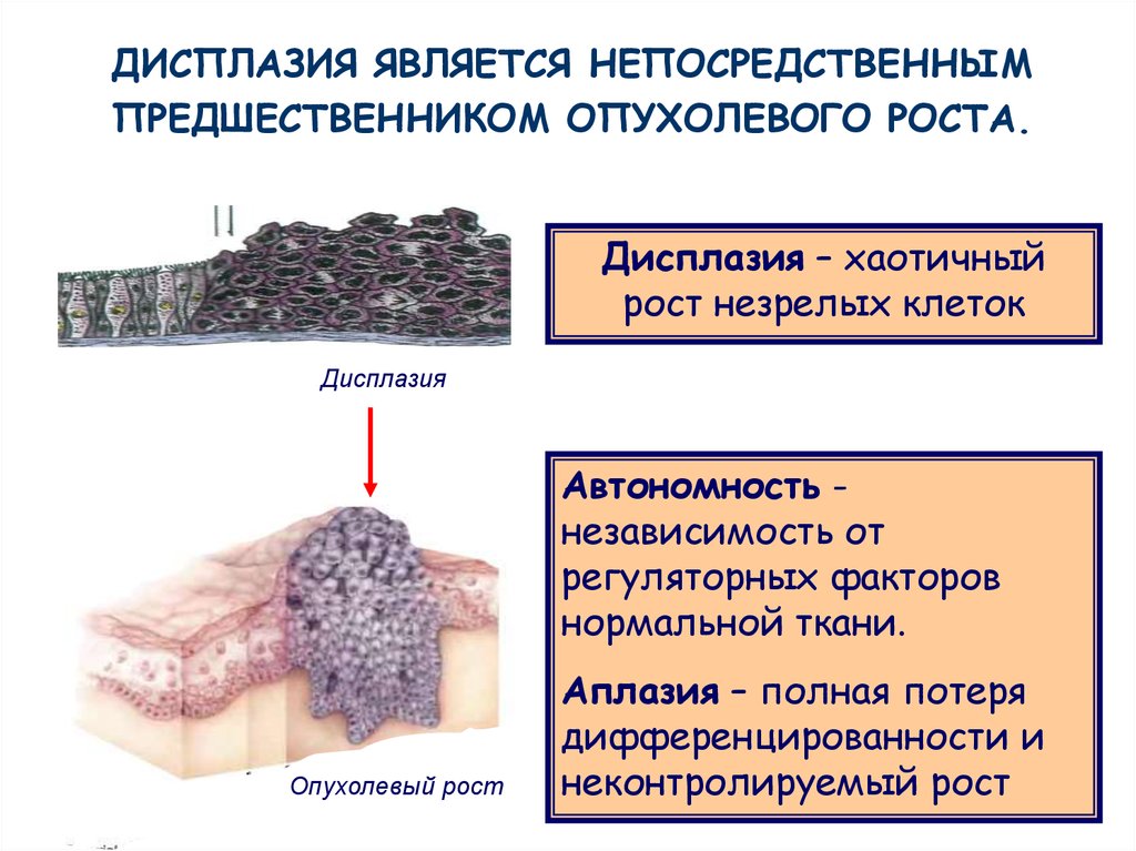 Нормальная ткань. Опухолевый рост патофизиология. Дисплазия опухолевых клеток. Патофизиология тканевого роста опухоли. Патофизиология опухоли презентация тканевой рост - это.