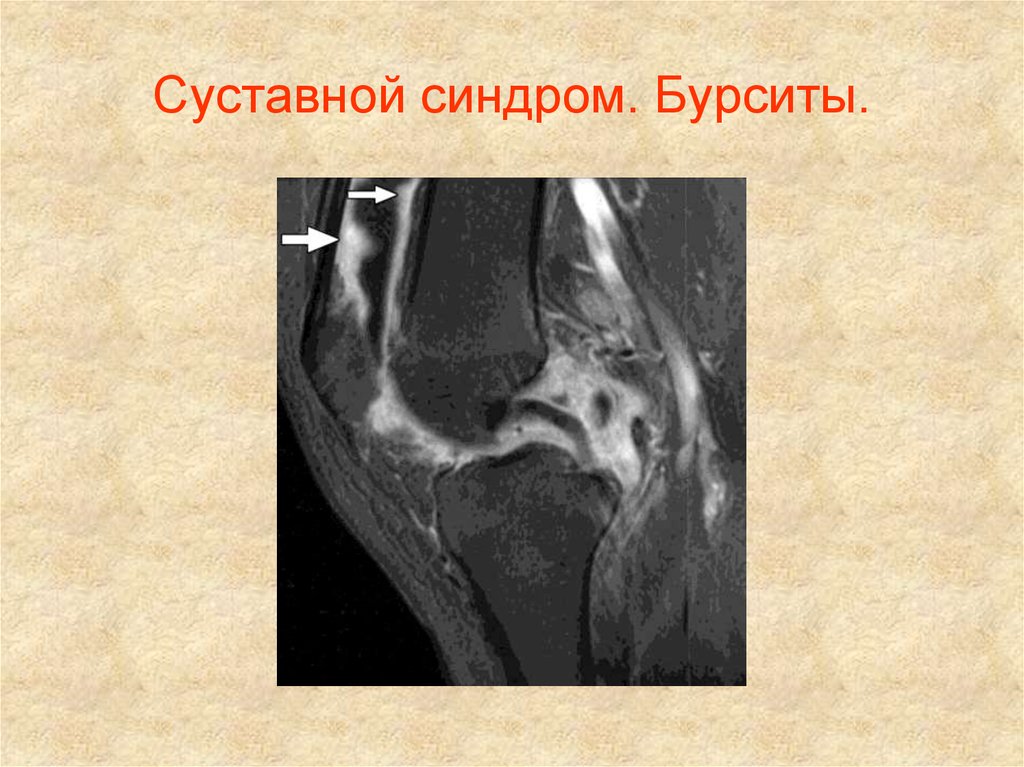 Дегенеративный отек костного мозга. Отек костного мозга бедренной кости. Отек костного мозга при ревматоидном артрите.