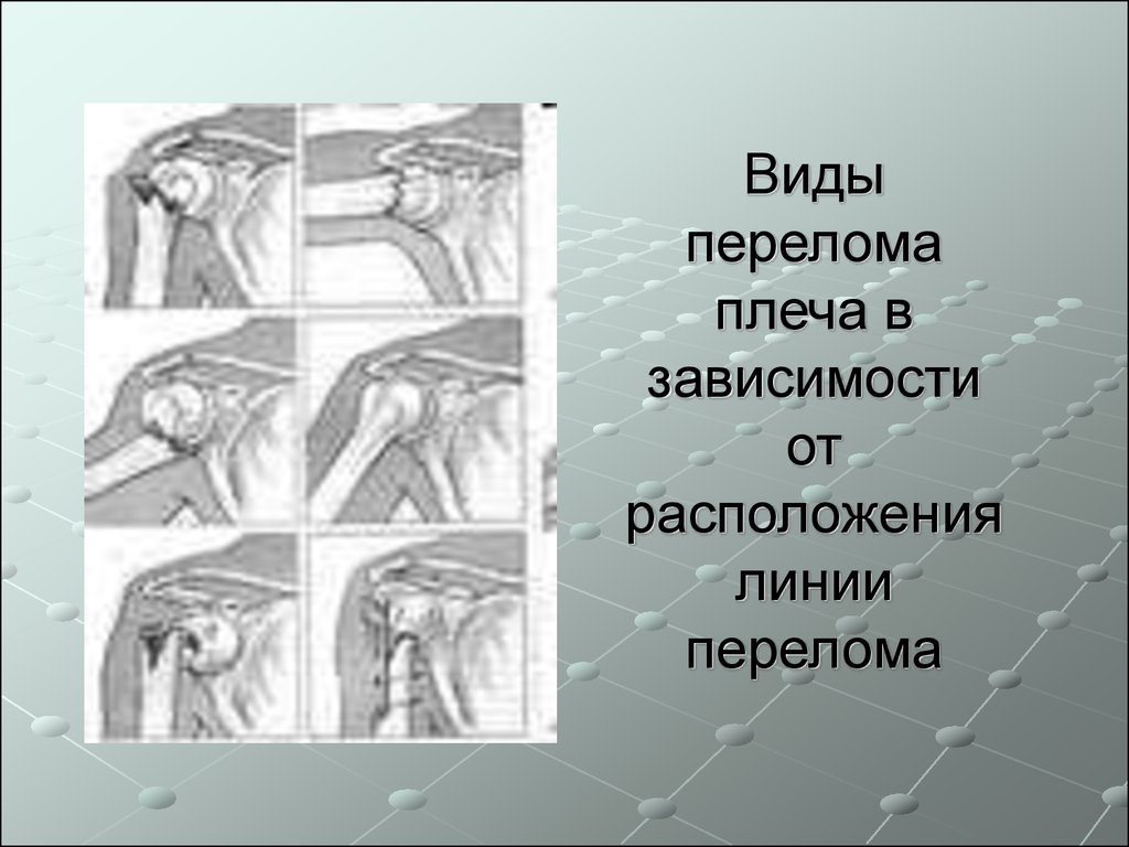 Перелом плеча. Переломы плеча презентация. Активные движения при переломе плеча. Симптомы при переломе плечевой кости.