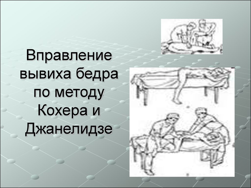 Вправление вывиха бедра методом Джанелидзе. Метод Джанелидзе тазобедренного. Вывих бедра по Кохеру Джанелидзе. Метод Джанелидзе вывих.