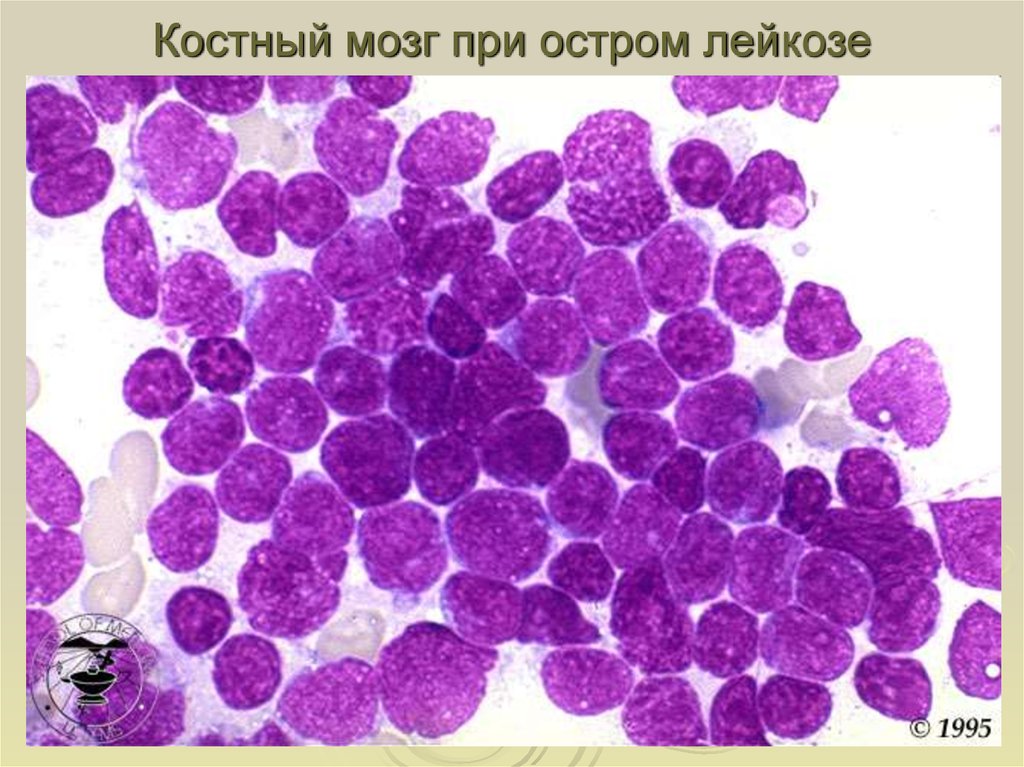 Картина крови и костного мозга при хроническом миелолейкозе истинной полицитемии