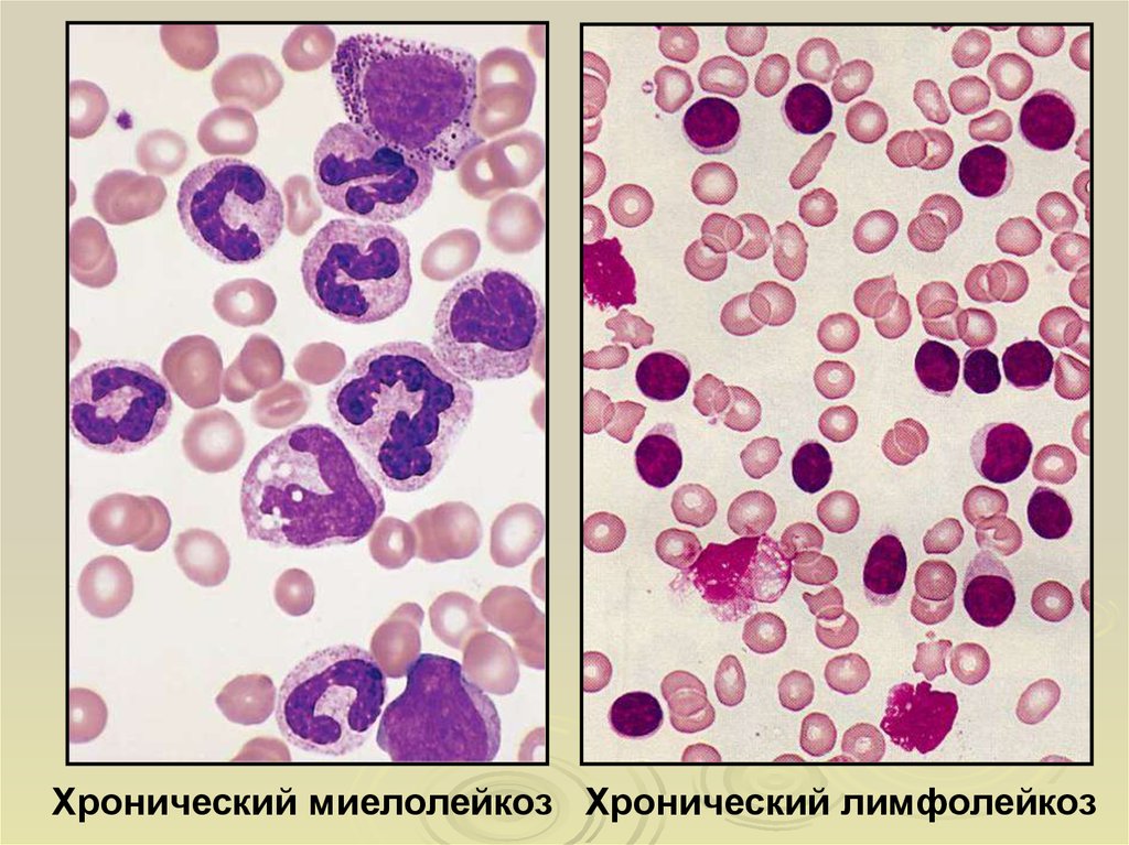 Картина крови и костного мозга при хроническом миелолейкозе истинной полицитемии