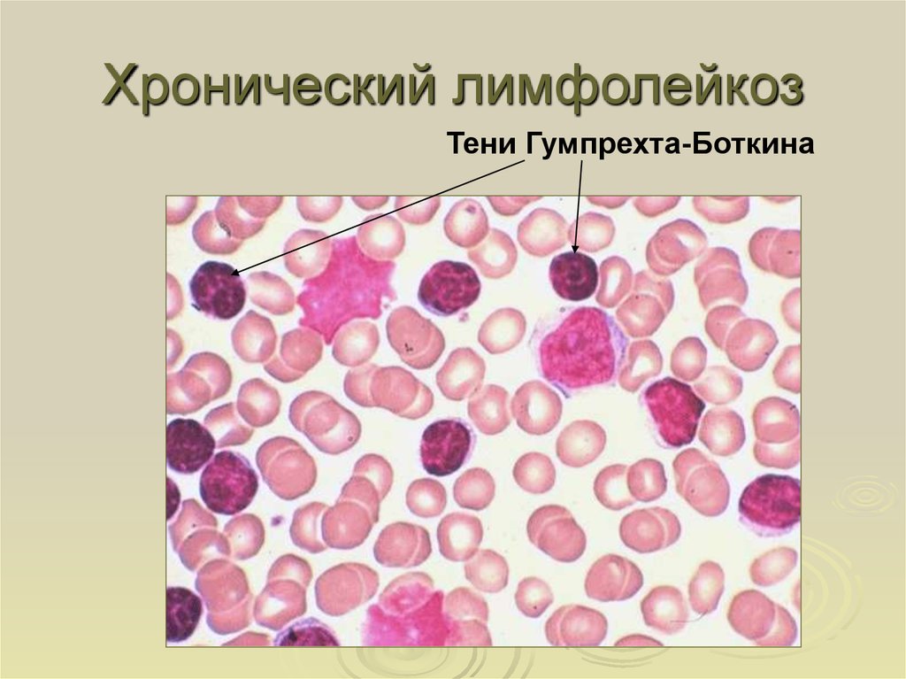 Клетки лимфолейкоза. Клетки лейколиза (тени Боткина-Гумпрехта). Тени Боткина Гумпрехта. Острый лимфобластный лейкоз тени Боткина Гумпрехта. Клетки Боткина Гумпрехта это.