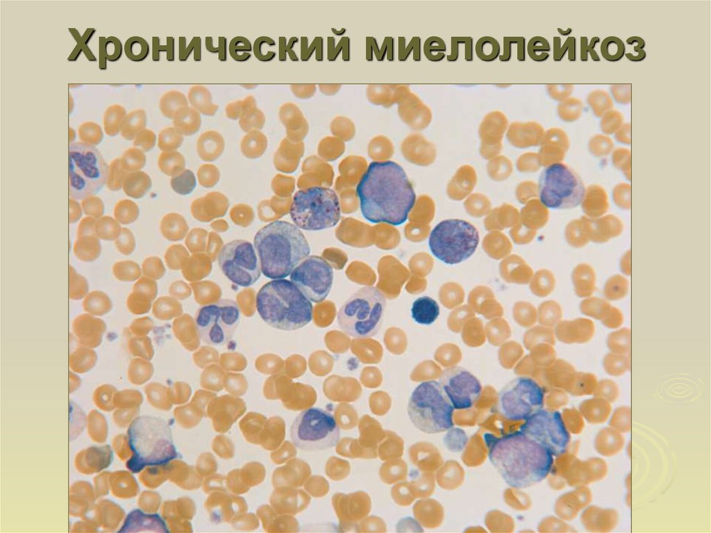 Миелолейкоз. Хронический миелоидный лейкоз. Хронический миелолейкоз миелоциты 8. Хронический миелобластный лейкоз картина крови. Микроскопия хронический миелобластный лейкоз.