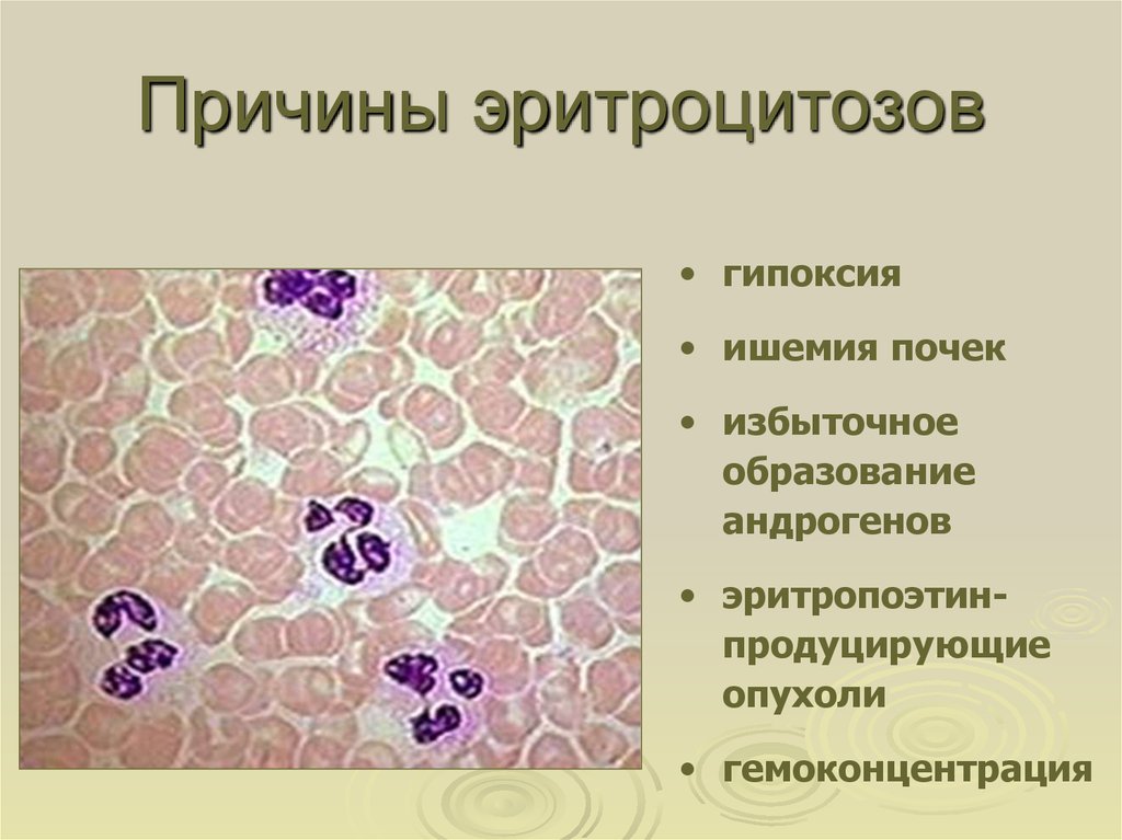 Эритроцитоз что это такое. Эритроцитоз причины. Причины первичного эритроцитоза. Причины вторичных относительных эритроцитозов.. Гипоксические эритроцитозы.