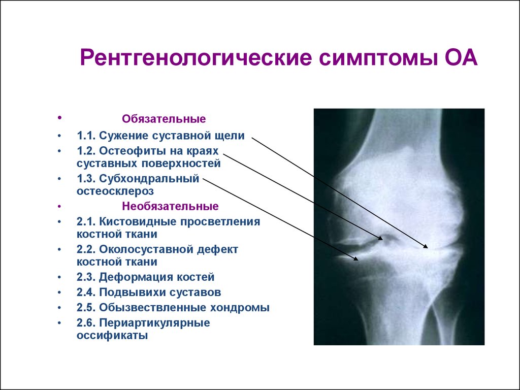 Субхондральный остеосклероз. Остеосклероз коленного сустава рентген. Рентгенологические стадии остеоартроза тазобедренного сустава. Суставные щели сужены тазобедренного сустава. Склероз бедренной кости рентген.