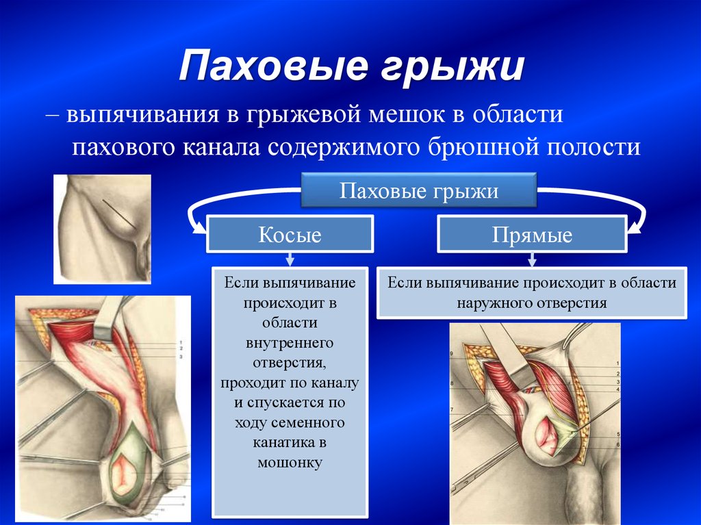 Паховая грыжа рисунок