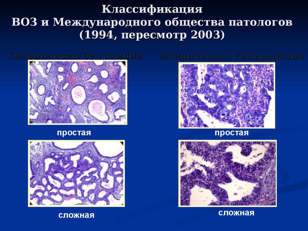 Железистая гиперплазия эндометрия после. Классификация гиперпластических процессов эндометрия воз 1994. Железистая гиперплазия эндометрия гистология классификация. Гиперпластические процессы эндометрия воз 1994. Полипозная гиперплазия эндометрия гистология.