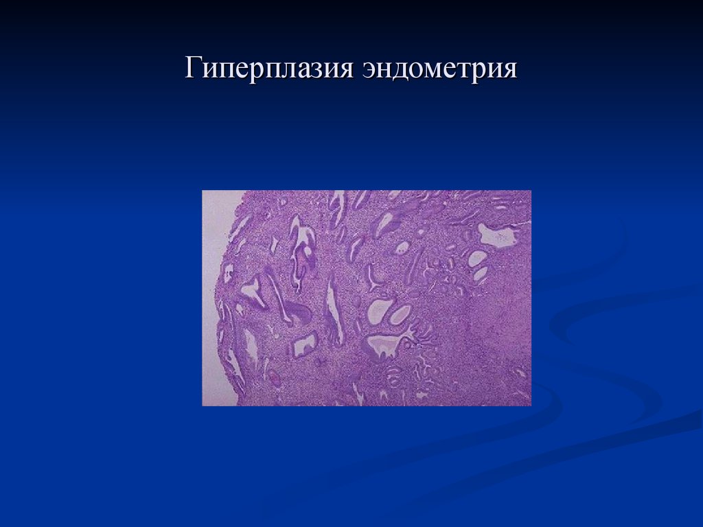 Патология эндометрия. Эндометриальный полип гистология. Патологическая гиперплазия. Гиперплазия эндометрия макропрепарат. Гиперплазия эндометрия ppt.