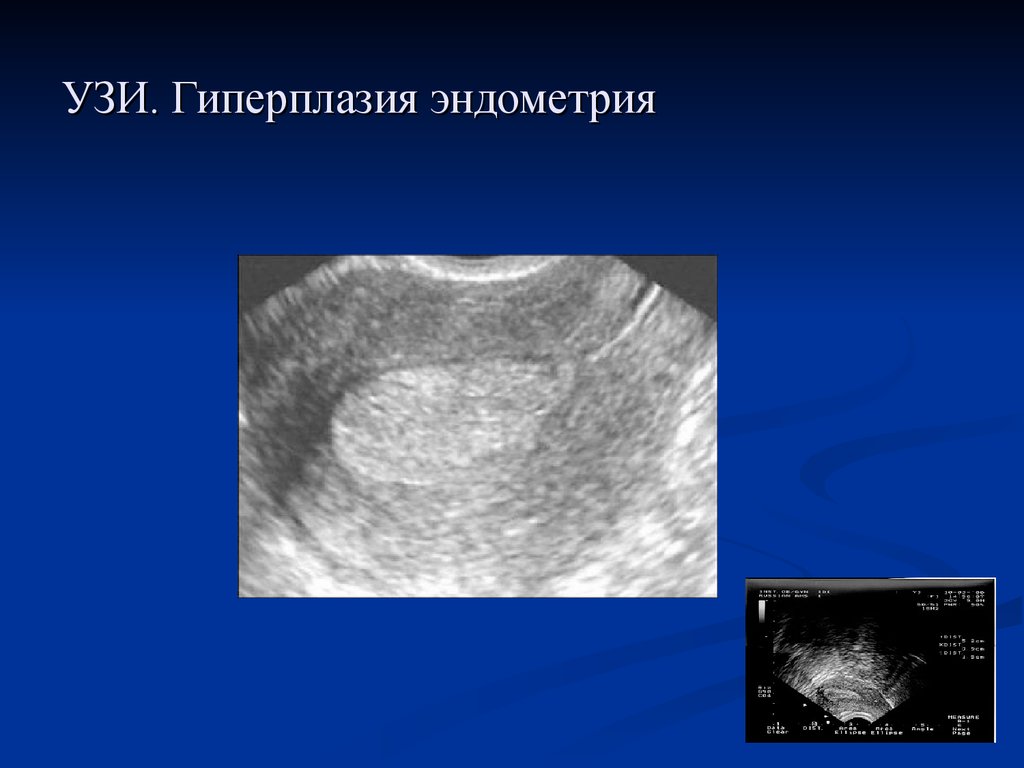 Эндометриоз видно на узи. Атипическая гиперплазия эндометрия УЗИ. Гиперпластические процессы эндометрия УЗИ. Гиперплазия эндометрия матки по УЗИ. Железистая гиперплазия эндометрия по УЗИ.
