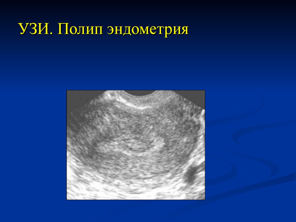 Эндометрия 23. Фиброзный полип эндометрия УЗИ. Гидросонография полипы. Полипоз эндометрия на УЗИ. Аденоматозные полип эндометрия УЗИ.