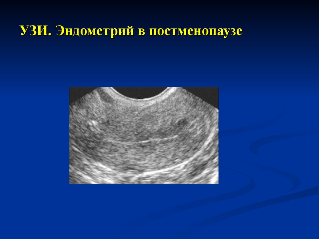 Климакс на узи. Эндометрия матки УЗИ гиперплазия эндометрия. Гиперплазия эндометрия в менопаузе УЗИ. Гиперплазия эндометрия в постменопаузе по УЗИ.