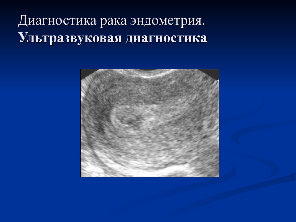 Эндометрия это. Аденокарцинома эндометрия УЗИ. Опухоль эндометрия на УЗИ. Атипичная гиперплазия эндометрия УЗИ.