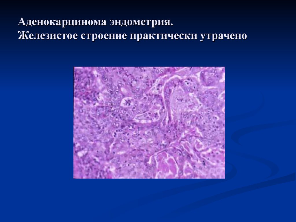 Плоскоклеточный эндометрий. Железистая гиперплазия гистология. Высокодифференцированная аденокарцинома эндометрия гистология. Гиперплазия эндометрия гистология. Аденокарцинома шейки матки гистология.