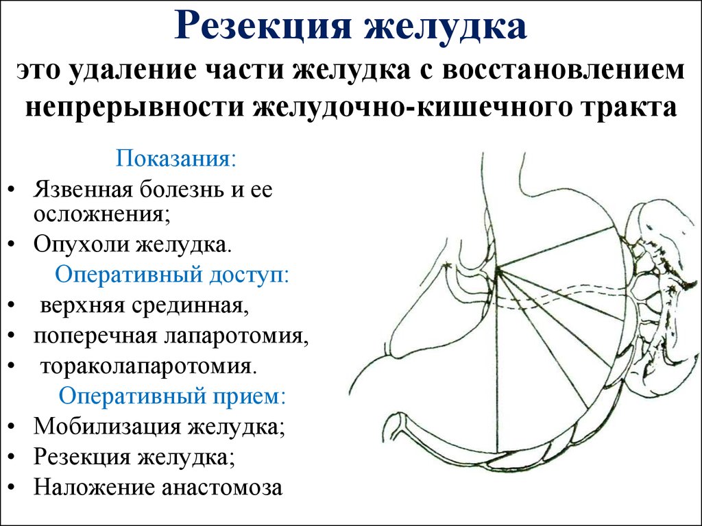 Схема операции изолированного желудочка по гейденгайну и по павлову