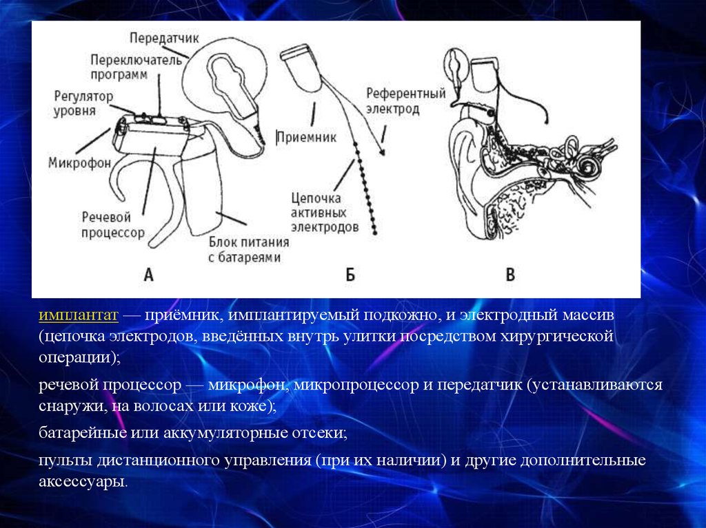 Схема работы кохлеарного импланта