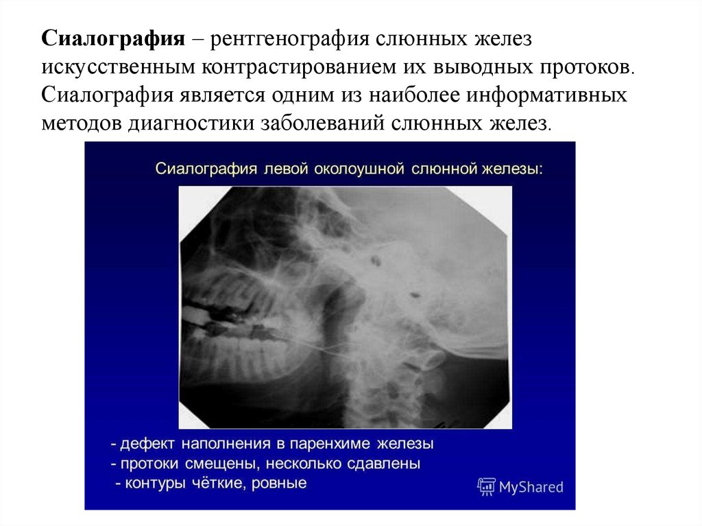 Лучевая диагностика заболеваний слюнных желез презентация