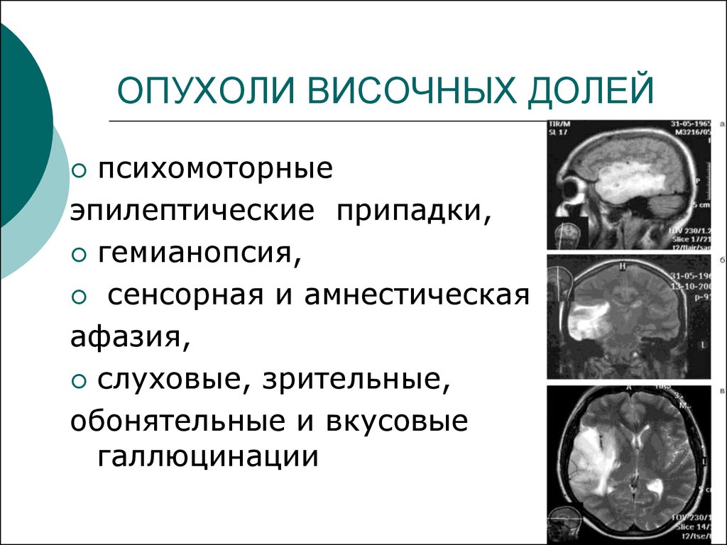 Опухоль правого. Клиника опухолей височной доли. Клинические проявления опухоли головного мозга. Опухоль височной доли головного мозга диагностика. Симптомы поражения лобной доли головного мозга опухоль.