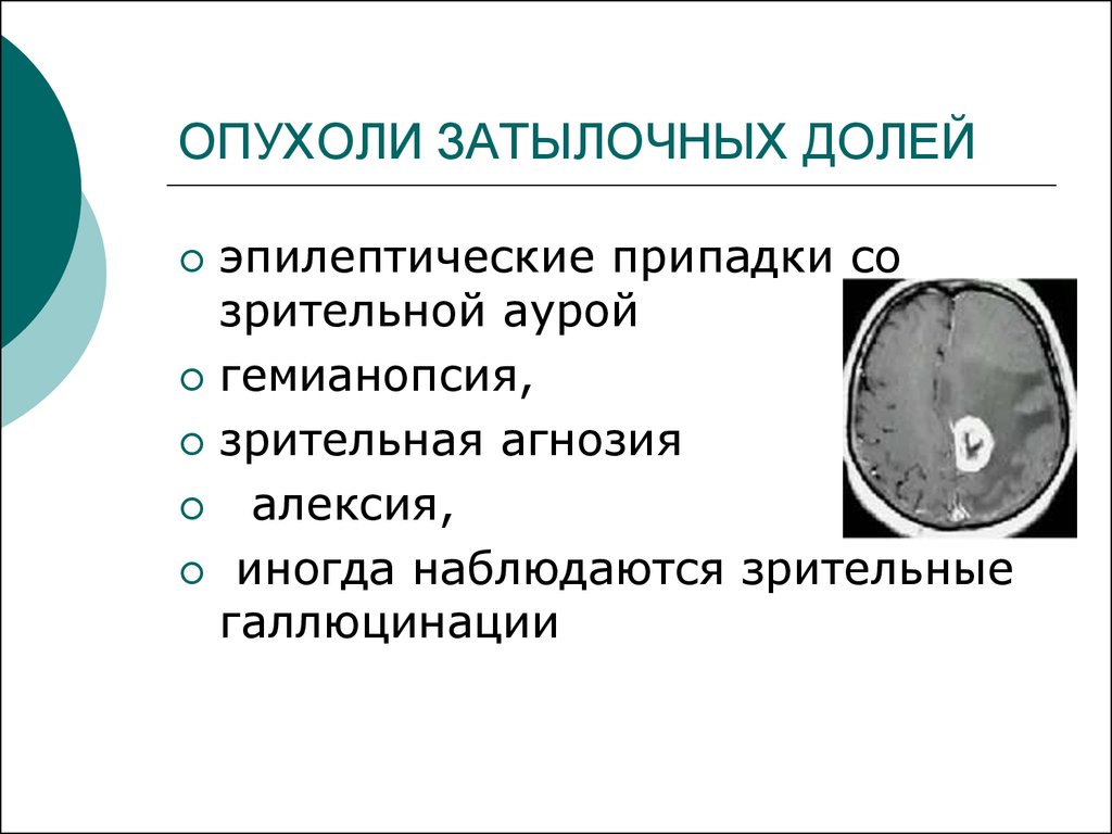 Опухоль головного мозга первый симптом. Опухоль затылочной доли головного мозга симптомы. Клиника, диагностика опухолей затылочной доли. Опухоль головного мозга затылочной доли мозга. Клиника опухоли затылочной доли головного мозга.