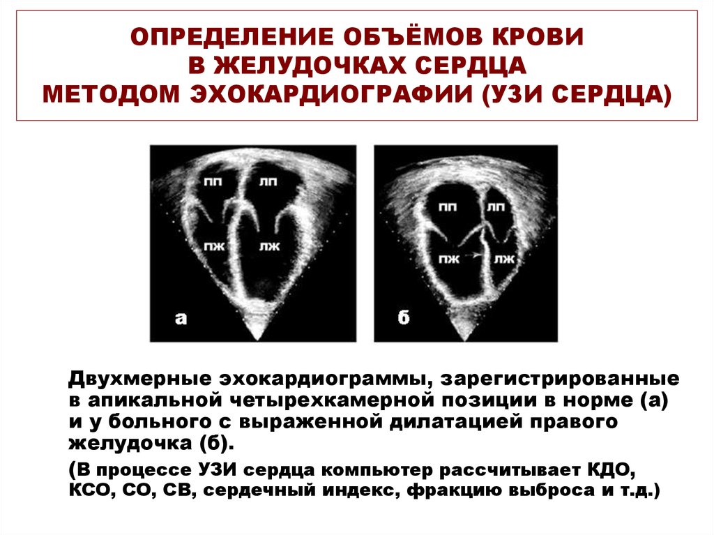 Желудочка сердца расширена. Объем желудочков сердца. Конечно-диастолический объем желудочков сердца. Измерение правого желудочка на УЗИ сердца-. Определить ударный объем левого желудочка..