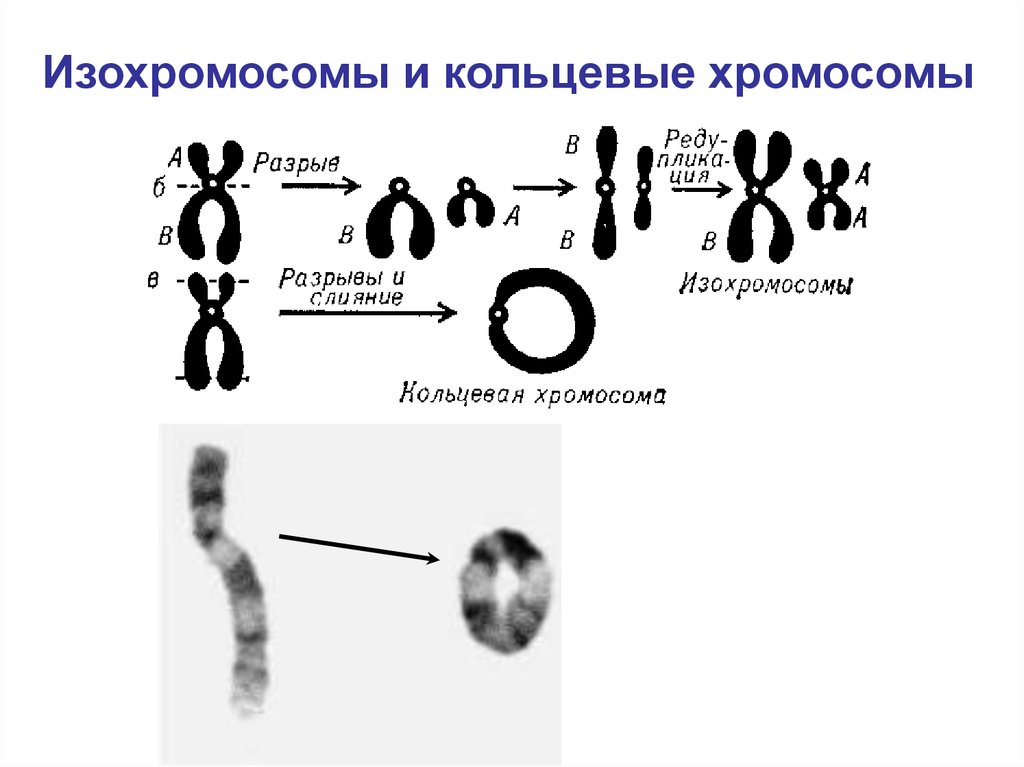 Имеется кольцевая хромосома. Кольцевая хромосома в кариотипе. Дицентрическая хромосома. Хромосомные болезни кольцевые хромосомы. Ана-телофазного метода анализа хромосомных аберраций.