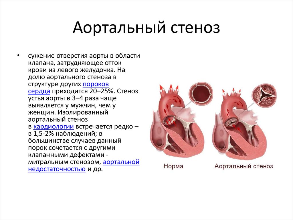 Сердечный стеноз. Стеноз аортального клапана клапан. Стеноз устья аортального клапана. Стеноз отверстия аортального клапана. Врожденный стеноз устья аорты.