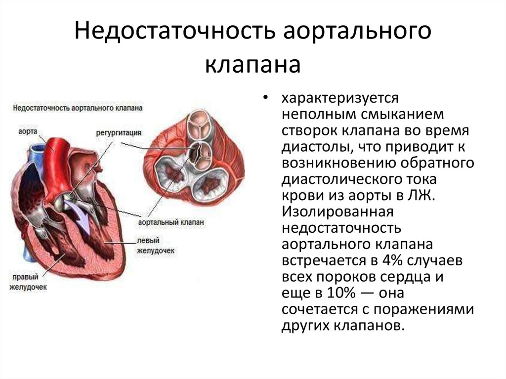 Поражение митрального клапана. Порок аортального клапана сердца. Аортальный клапан 3 створчатый. Недостаточность аортального клапана порок сердца. Недостаточность аортального клапана 1 ст.