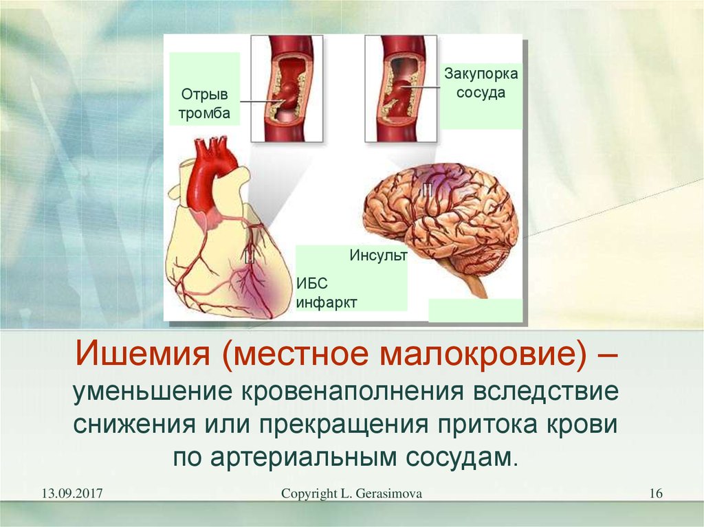 Что такое ишемия. Отрыв тромба в артерии. Ишемия местное малокровие. Кровенаполнение сосудов.