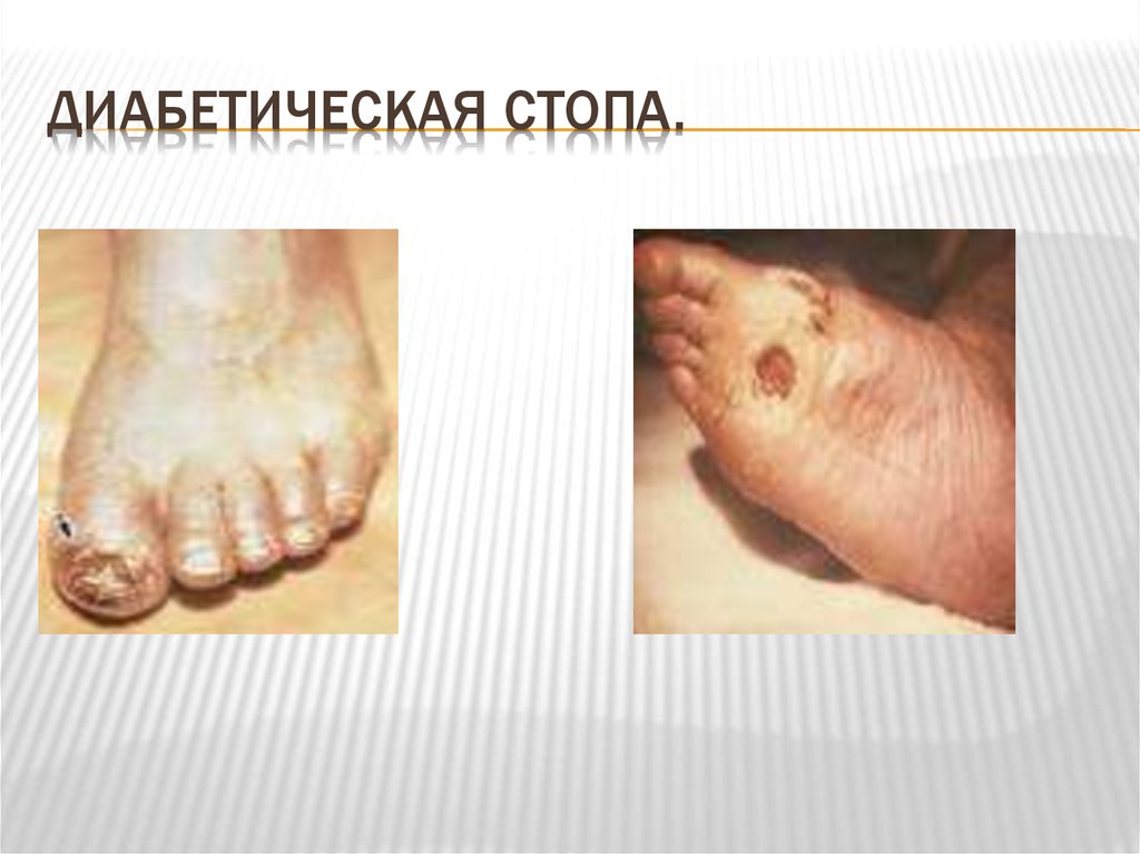 Диабетическая стопа.
