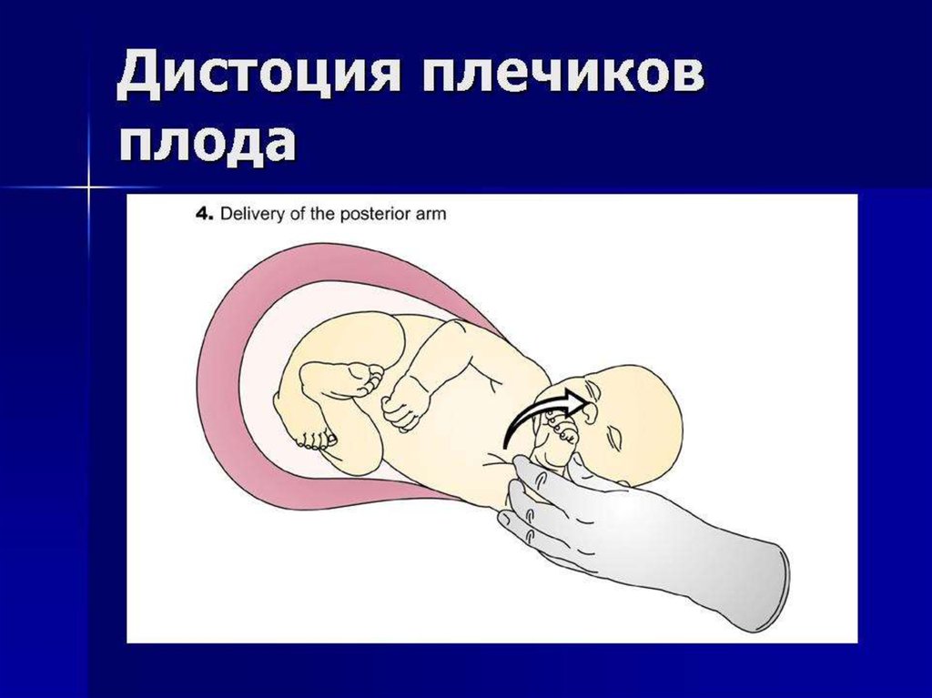 Дистоция плечиков презентация