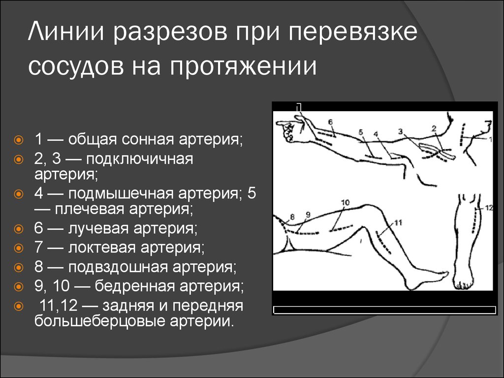 Перевязка в ране и на протяжении. Линии разрезов при перевязке сосудов на протяжении. Перевязка артерии на протяжении. Перевязка сосуда на протяжении. Перевязка бедренной артерии.