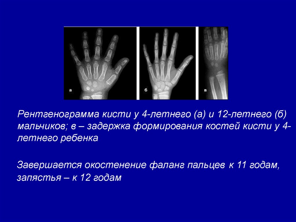 Костный возраст. Костный Возраст по рентгенограмме кисти 4 года таблица. Рентген кисти руки на костный Возраст. Рентгенограмма костей кистей рук костный Возраст. Костный Возраст по рентгенограмме кисти 4 года.